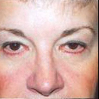 Rhinoplasty Before & After