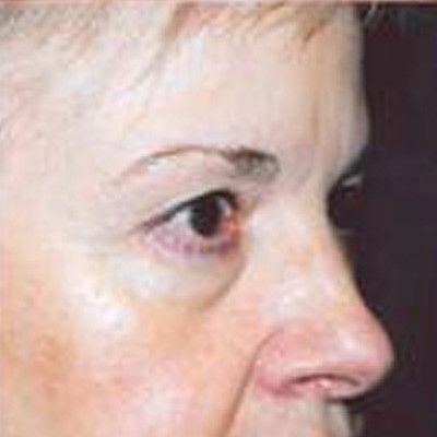 Rhinoplasty Before & After