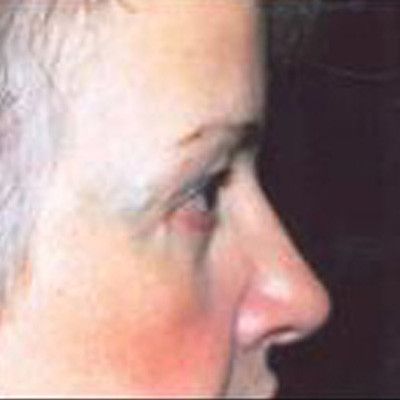 Rhinoplasty Before & After