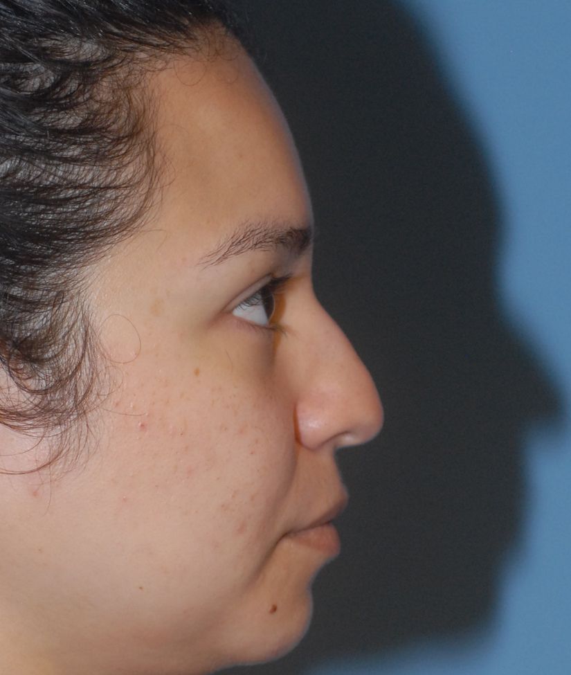Rhinoplasty Before & After