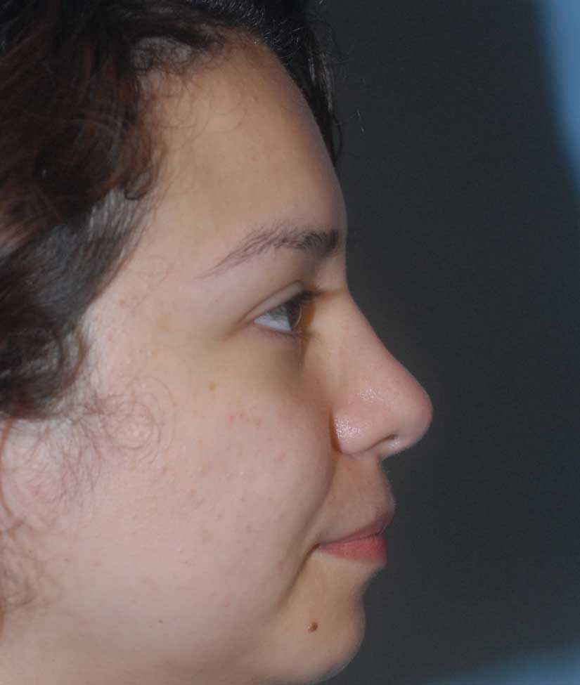 Rhinoplasty Before & After