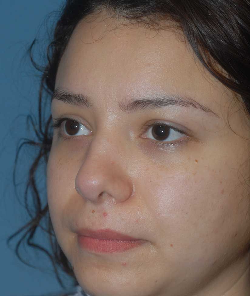 Rhinoplasty Before & After