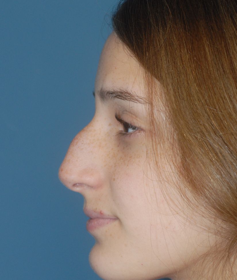 Rhinoplasty Before & After