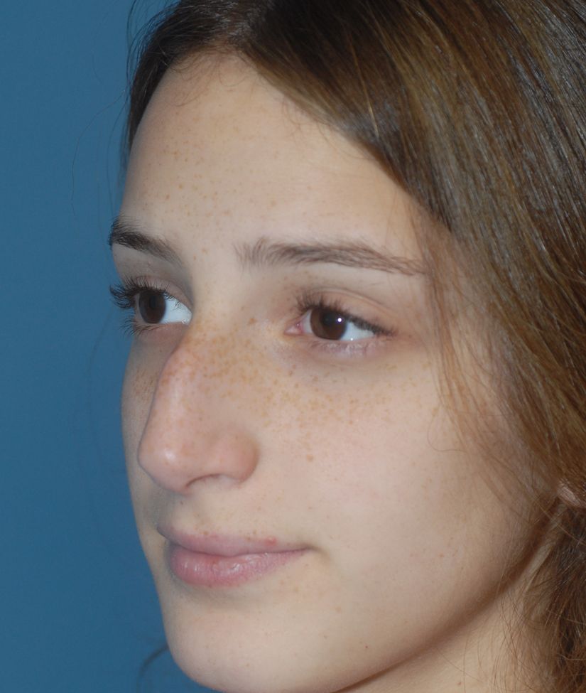 Rhinoplasty Before & After