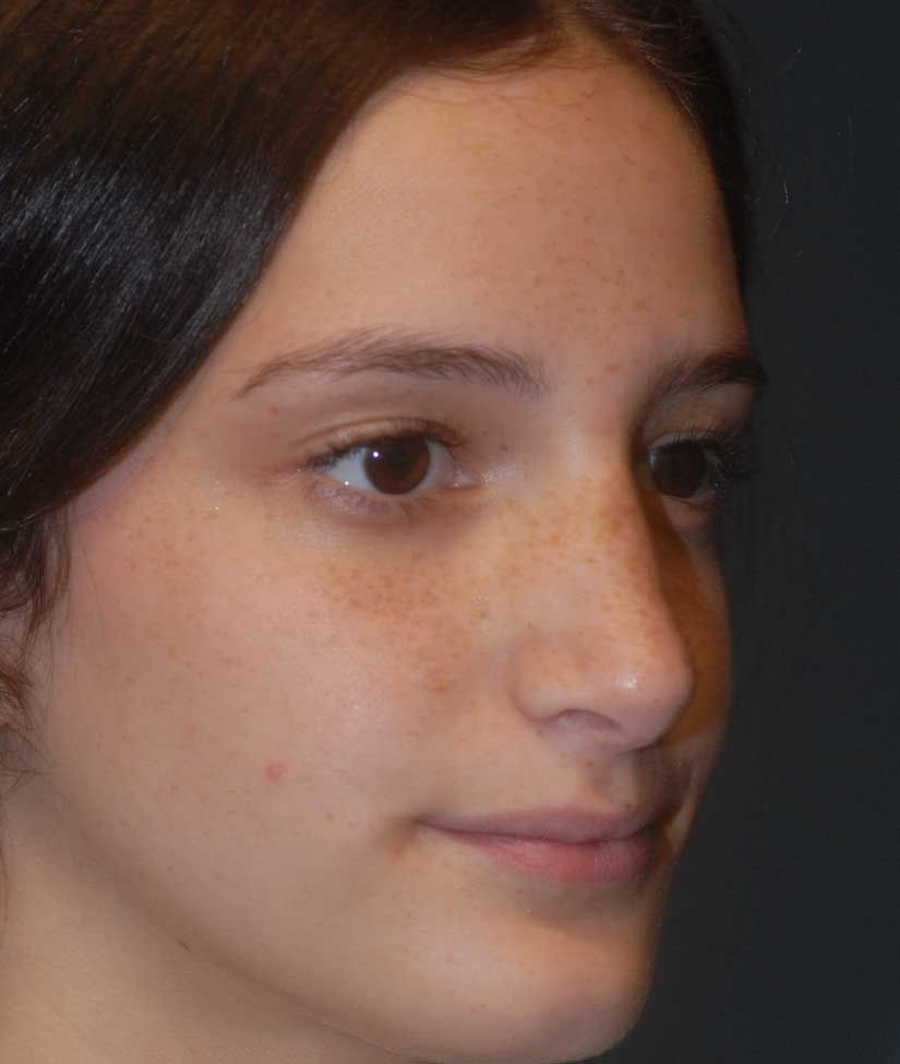 Rhinoplasty Before & After