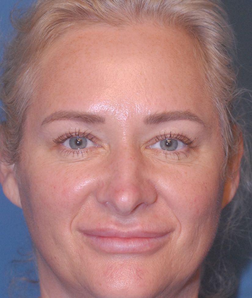 Rhinoplasty Before & After