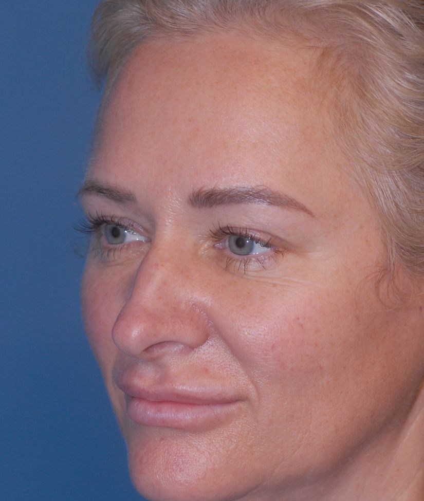 Rhinoplasty Before & After