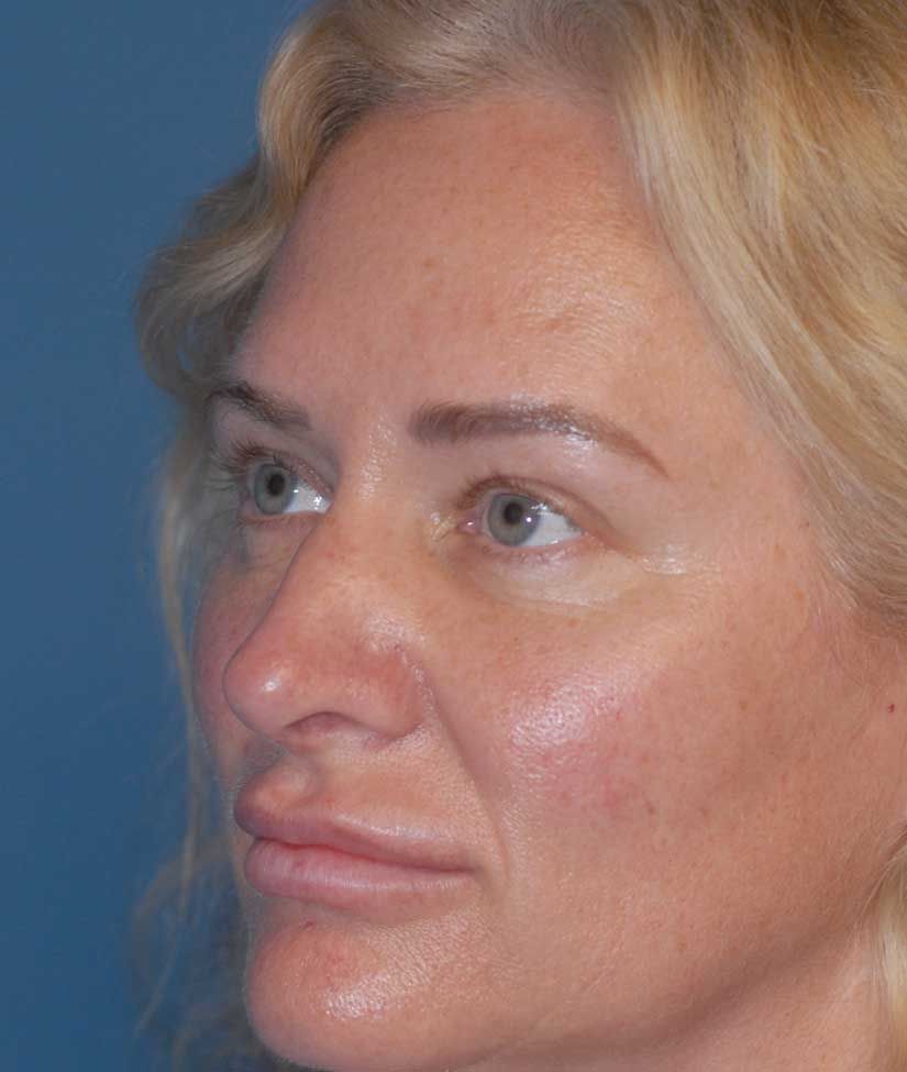 Rhinoplasty Before & After