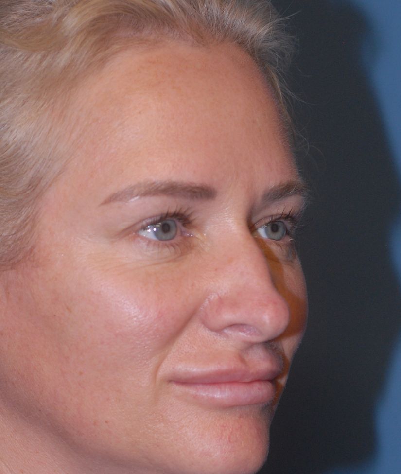 Rhinoplasty Before & After