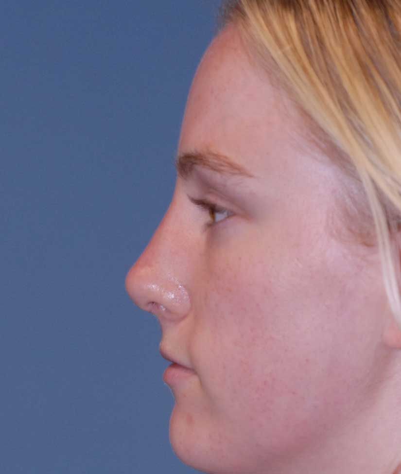 Rhinoplasty Before & After