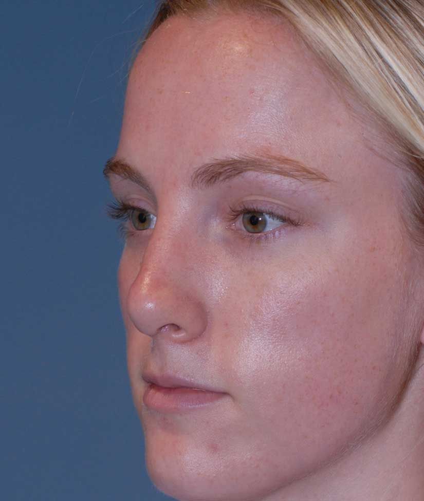Rhinoplasty Before & After