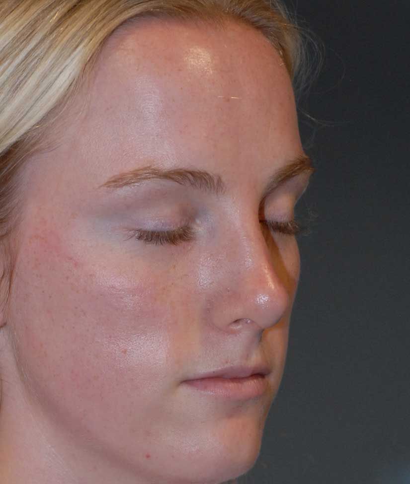 Rhinoplasty Before & After