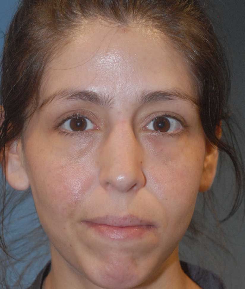 Rhinoplasty Before & After