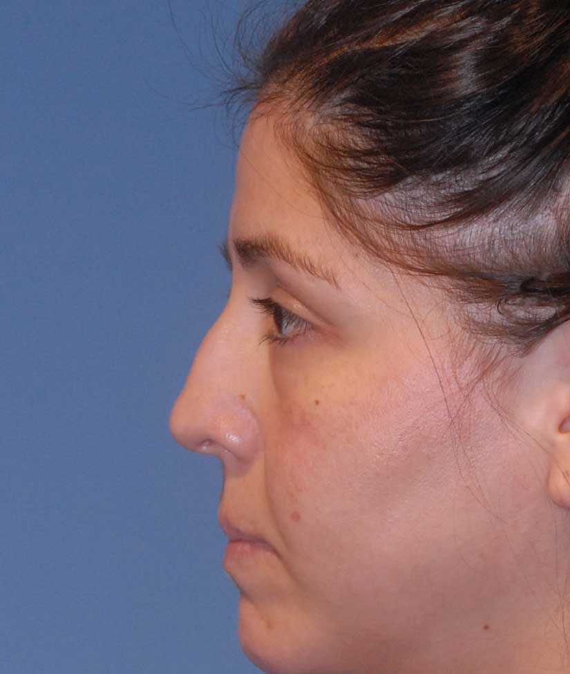 Rhinoplasty Before & After