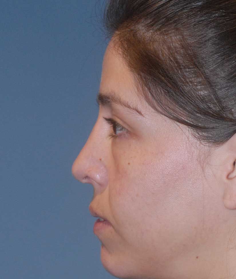 Rhinoplasty Before & After