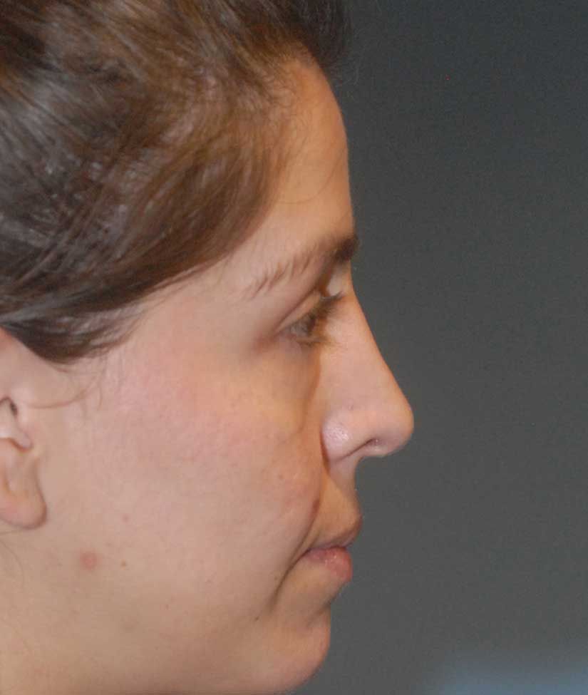 Rhinoplasty Before & After