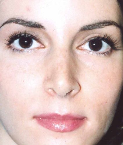 Rhinoplasty Before & After