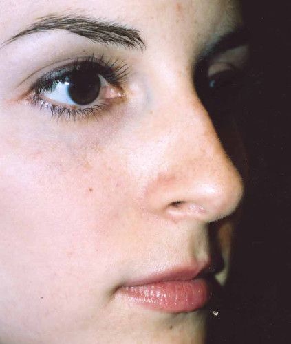 Rhinoplasty Before & After