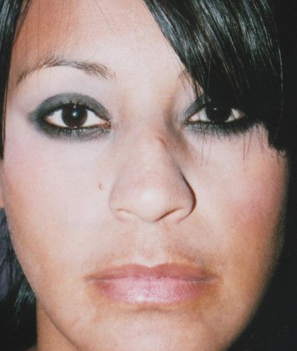 Rhinoplasty Before & After