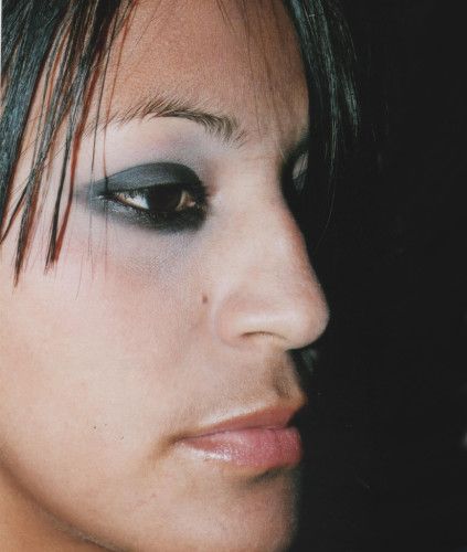 Rhinoplasty Before & After