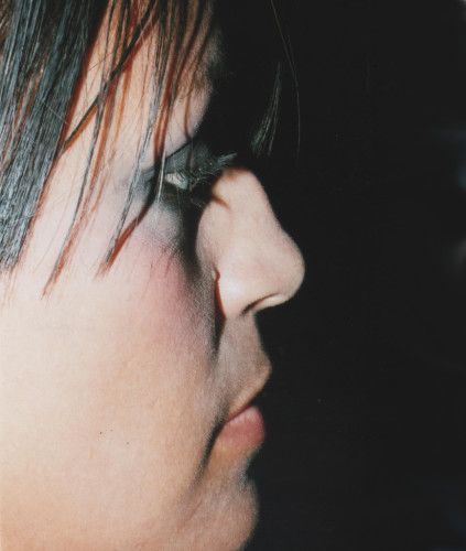 Rhinoplasty Before & After