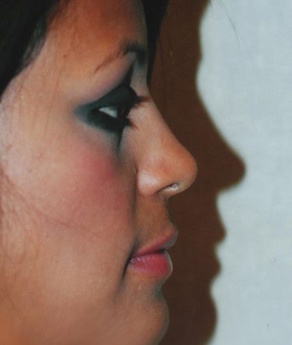 Rhinoplasty Before & After