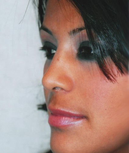 Rhinoplasty Before & After