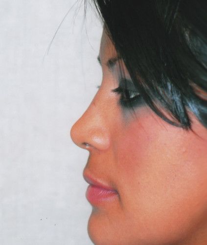 Rhinoplasty Before & After