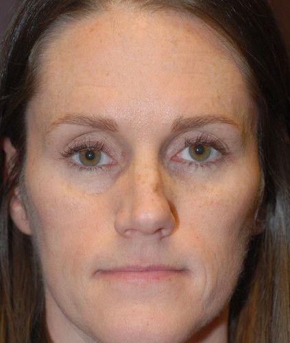 Rhinoplasty Before & After