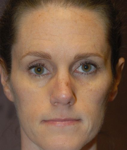 Rhinoplasty Before & After