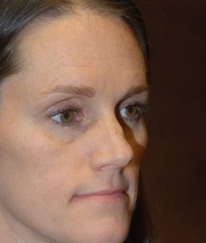 Rhinoplasty Before & After