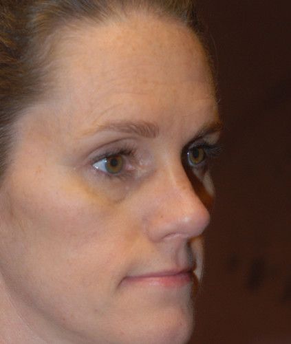 Rhinoplasty Before & After