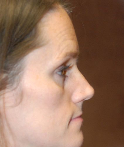 Rhinoplasty Before & After