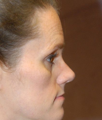 Rhinoplasty Before & After