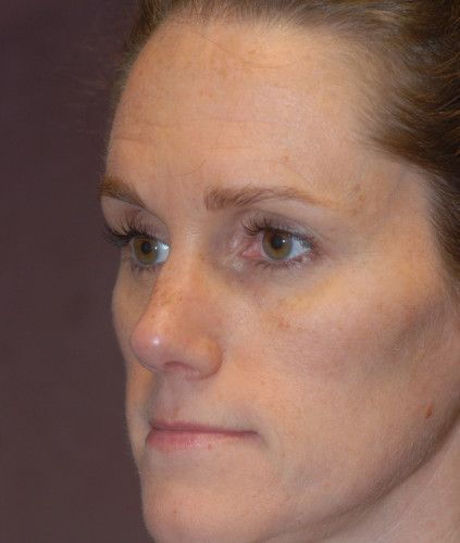 Rhinoplasty Before & After