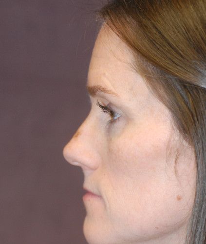 Rhinoplasty Before & After
