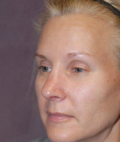 Rhinoplasty Before & After