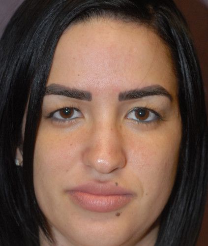 Rhinoplasty Before & After