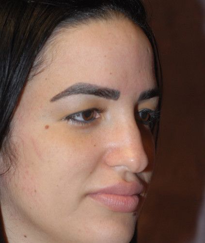 Rhinoplasty Before & After