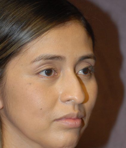 Rhinoplasty Before & After