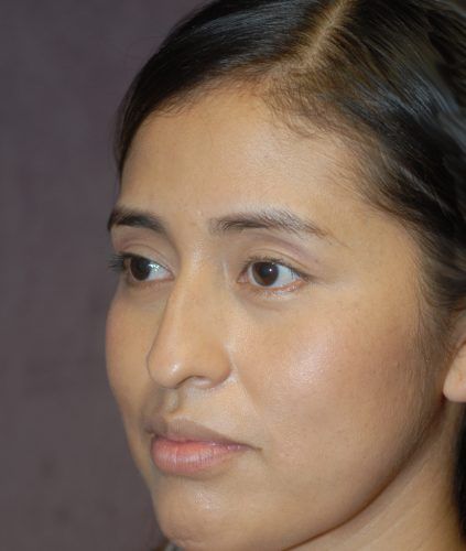 Rhinoplasty Before & After