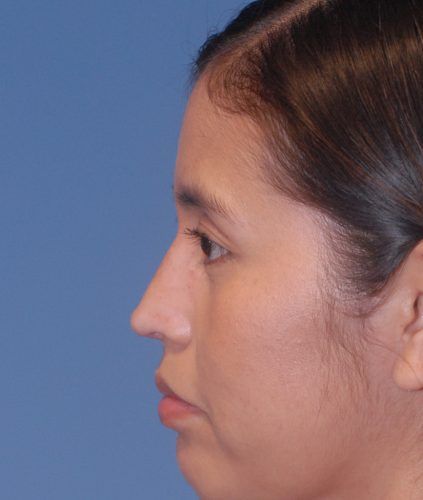 Rhinoplasty Before & After