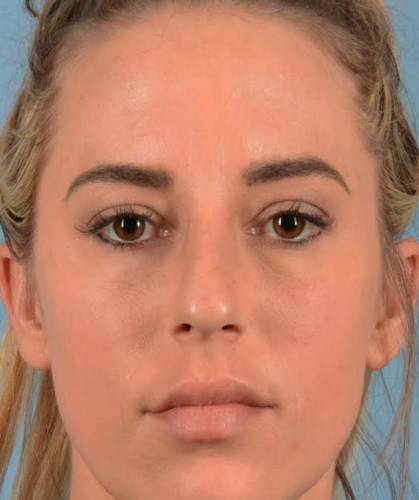 Rhinoplasty Before & After