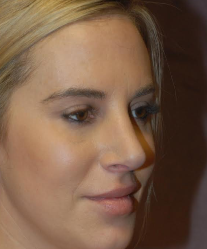 Rhinoplasty Before & After