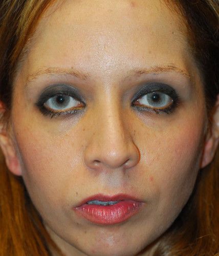 Rhinoplasty Before & After