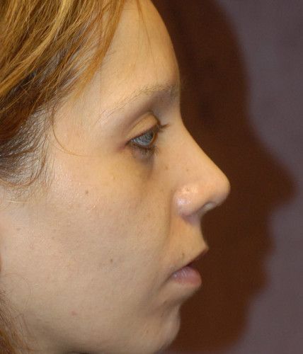 Rhinoplasty Before & After