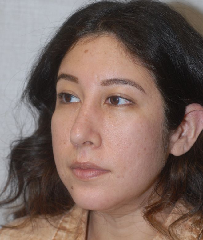 Rhinoplasty Before & After