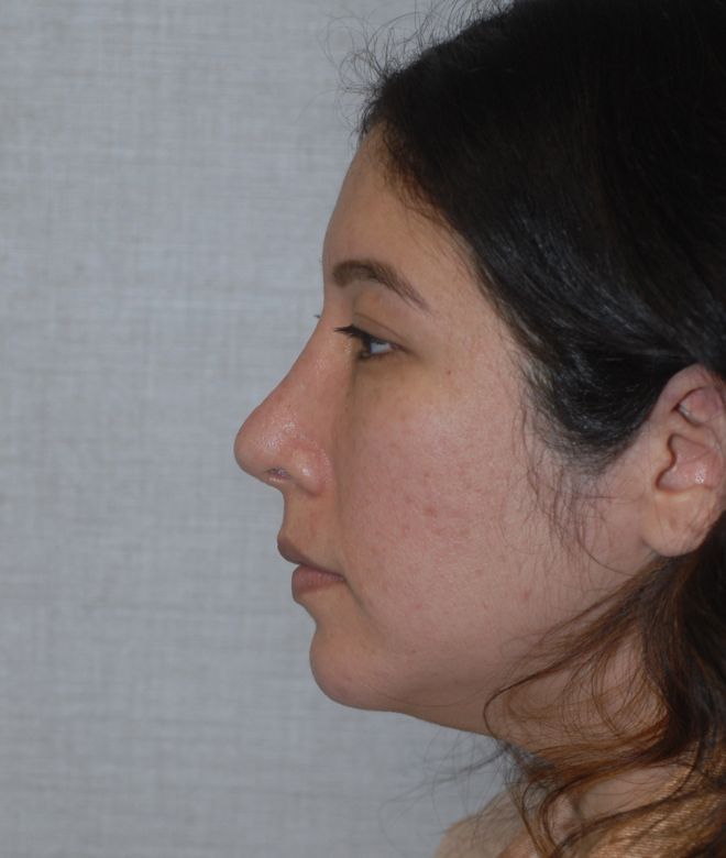 Rhinoplasty Before & After