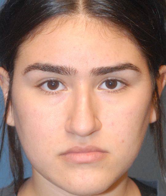 Rhinoplasty Before & After