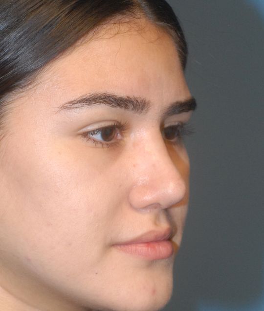 Rhinoplasty Before & After